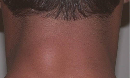 Bướu mỡ - Hình ảnh minh họa